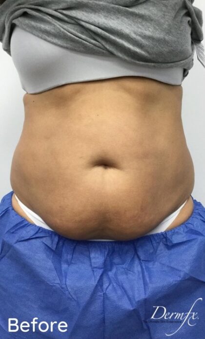 CoolSculpting Before & After Patient #686