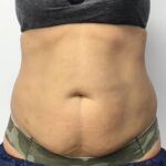 CoolSculpting Before & After Patient #686