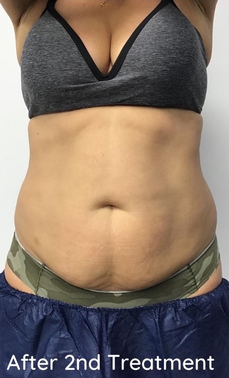 CoolSculpting Before & After Patient #686