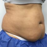 CoolSculpting Before & After Patient #686