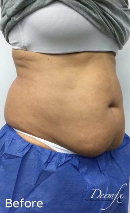 CoolSculpting Before & After Patient #686