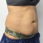 CoolSculpting Before & After Patient #686