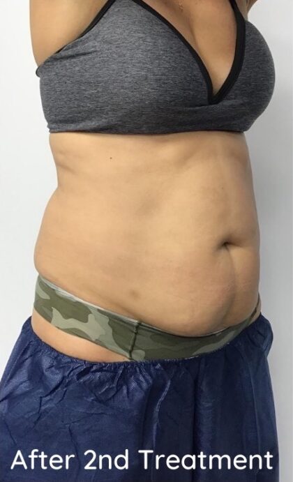 CoolSculpting Before & After Patient #686