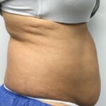 CoolSculpting Before & After Patient #686