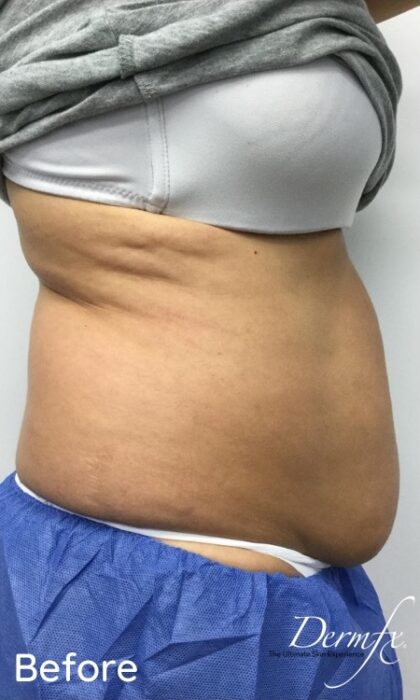 CoolSculpting Before & After Patient #686