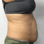 CoolSculpting Before & After Patient #686