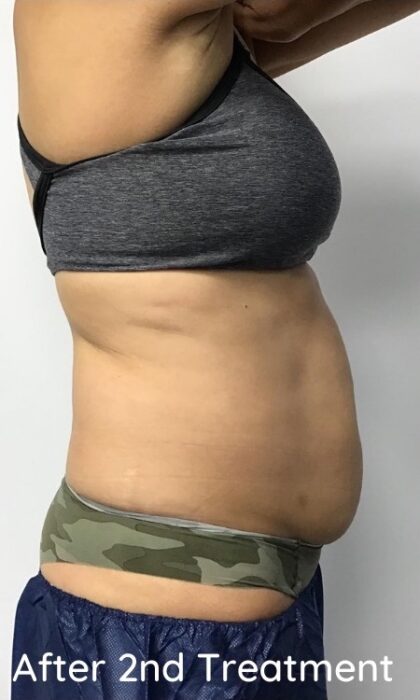 CoolSculpting Before & After Patient #686