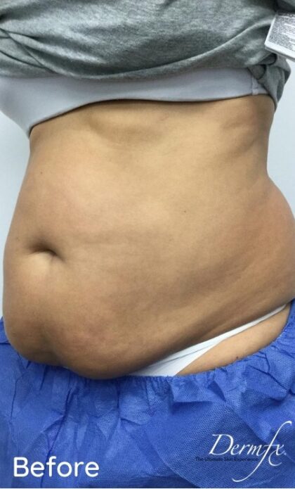 CoolSculpting Before & After Patient #686