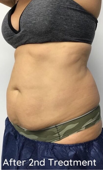 CoolSculpting Before & After Patient #686