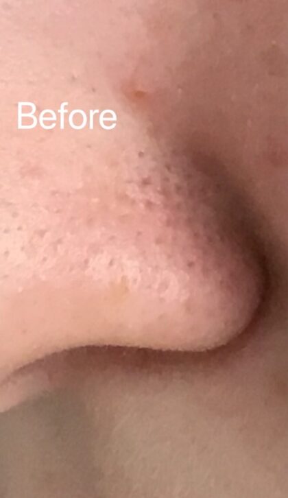 Hydrafacial Before & After Patient #695