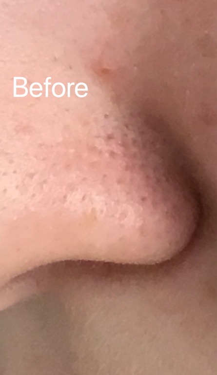 Hydrafacial Before & After Patient #695