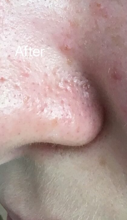 Hydrafacial Before & After Patient #695