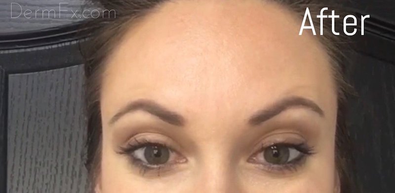 Dysport Before & After Patient #429