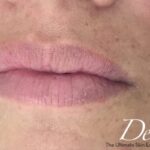 Lip Injections Before & After Patient #432