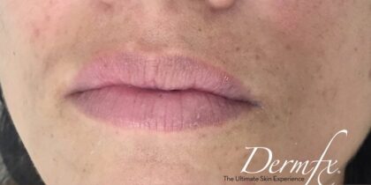 Lip Injections Before & After Patient #432