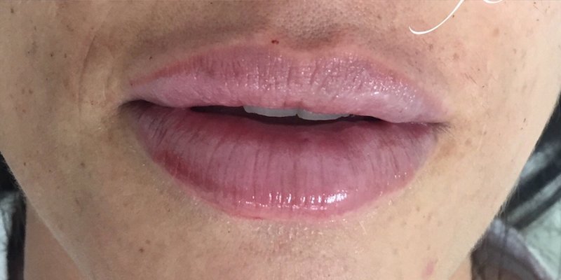 Lip Injections Before & After Patient #432