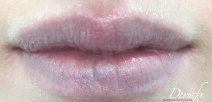 Lip Injections Before & After Patient #435