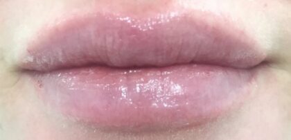 Lip Injections Before & After Patient #435