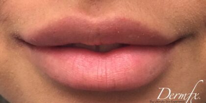 Lip Injections Before & After Patient #438