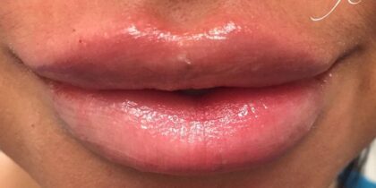 Lip Injections Before & After Patient #438