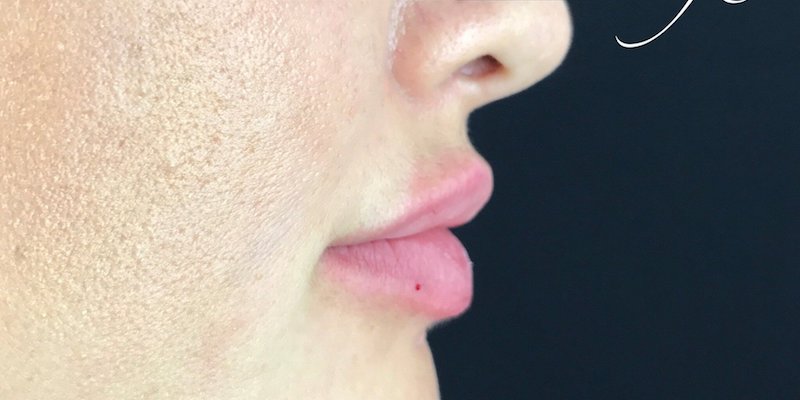 Lip Injections Before & After Patient #444