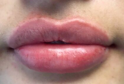 Lip Injections Before & After Patient #453