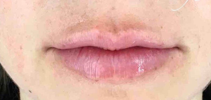 Lip Injections Before & After Patient #456