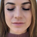 Juvederm Before & After Patient #459