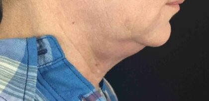 Kybella Before & After Patient #465