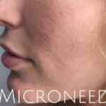 Microneedling Before & After Patient #475