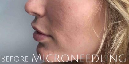 Microneedling Before & After Patient #475