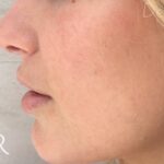 Microneedling Before & After Patient #475