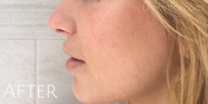 Microneedling Before & After Patient #475