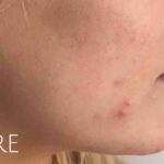 Microneedling Before & After Patient #475