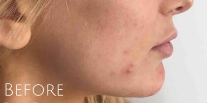 Microneedling Before & After Patient #475