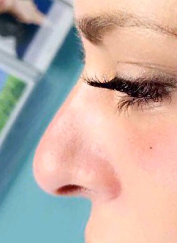 Non-Surgical Nose Job Before & After Patient #480