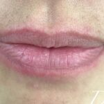 Lip Injections Before & After Patient #503