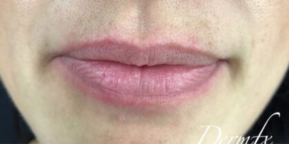 Lip Injections Before & After Patient #503