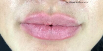 Lip Injections Before & After Patient #503