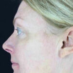 Ultherapy Before & After Patient #907