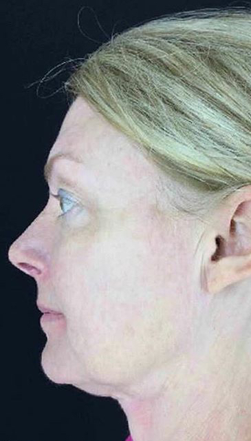 Ultherapy Before & After Patient #907