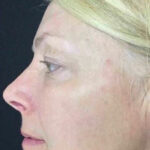 Ultherapy Before & After Patient #907