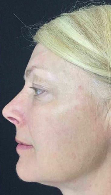 Ultherapy Before & After Patient #907