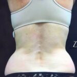 CoolSculpting Before & After Patient #407