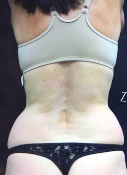 CoolSculpting Before & After Patient #407