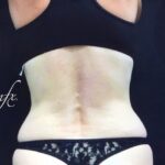 CoolSculpting Before & After Patient #407
