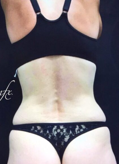 CoolSculpting Before & After Patient #407