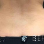 CoolSculpting Before & After Patient #410