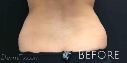 CoolSculpting Before & After Patient #410