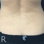 CoolSculpting Before & After Patient #410